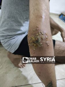 The hand of an illegal immigrant suffering from skin diseases in Libyan detention centers (Belaady Organization/Tarik Lamloum)
